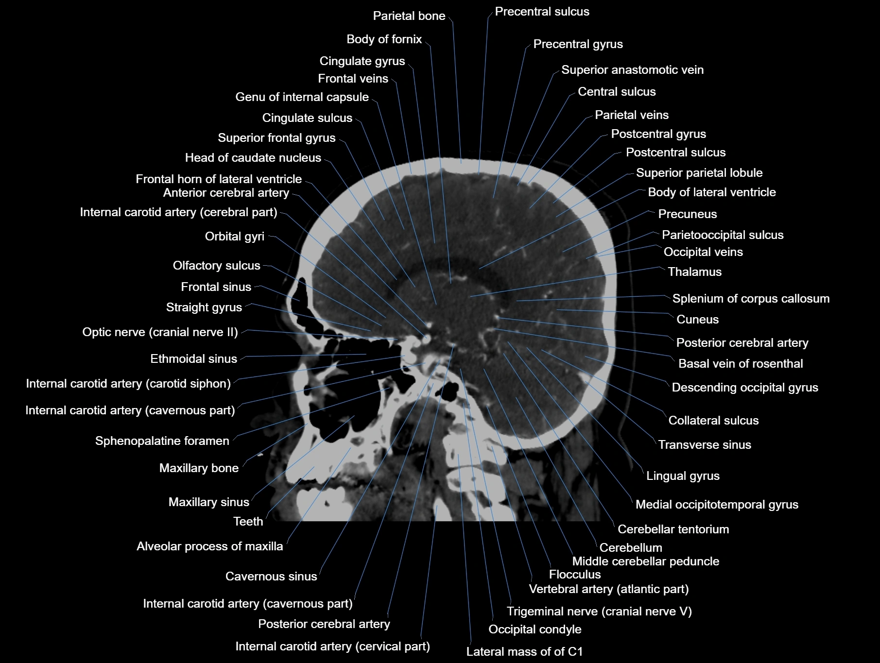 CT scan brain sagittal cross sectional anatomy image-img-00001-00033.webp